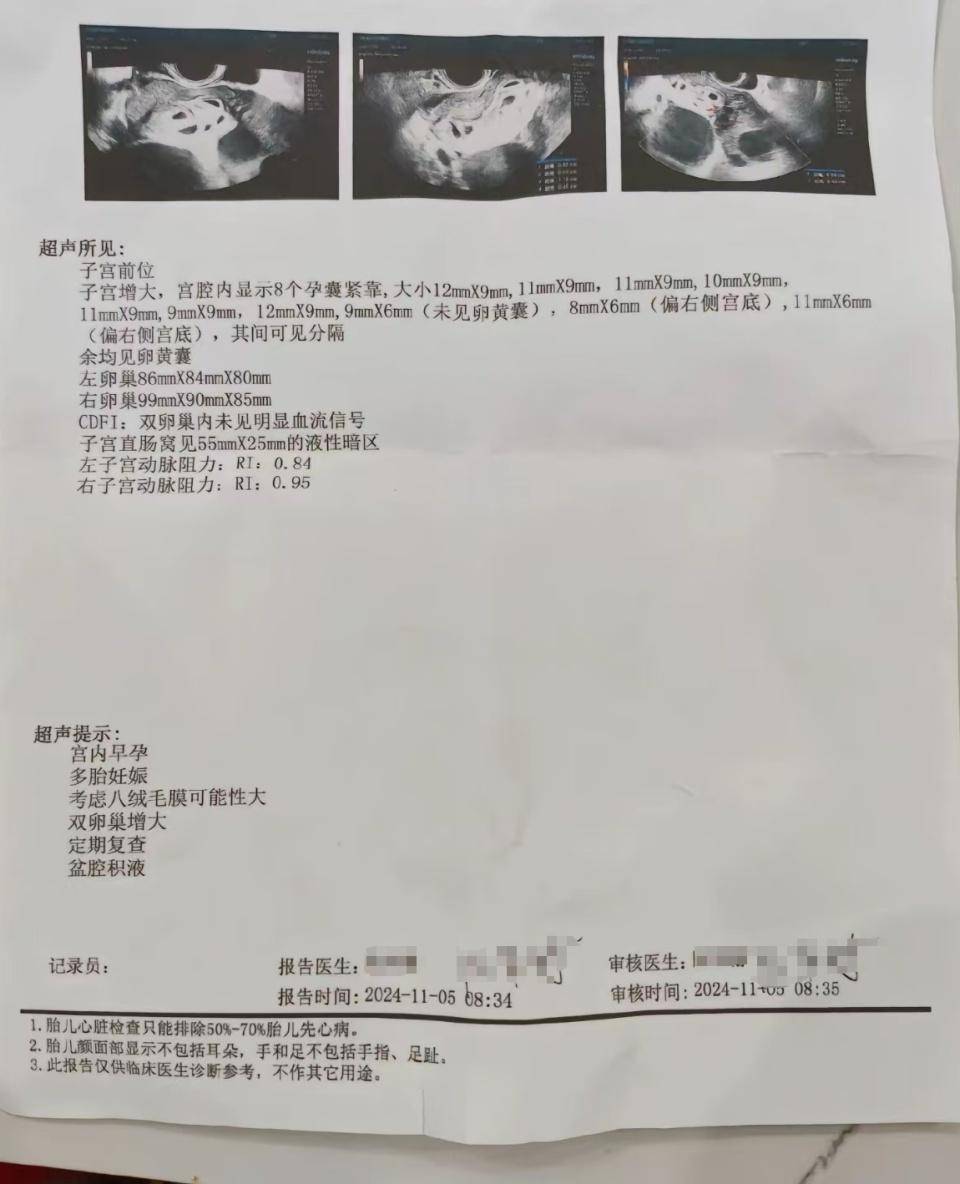 怀上9胞胎女子今日进行减胎手术：分两次进行<strong></p>
<p>证券交易费用</strong>，第一次减去四个胚胎，第二次减去三个