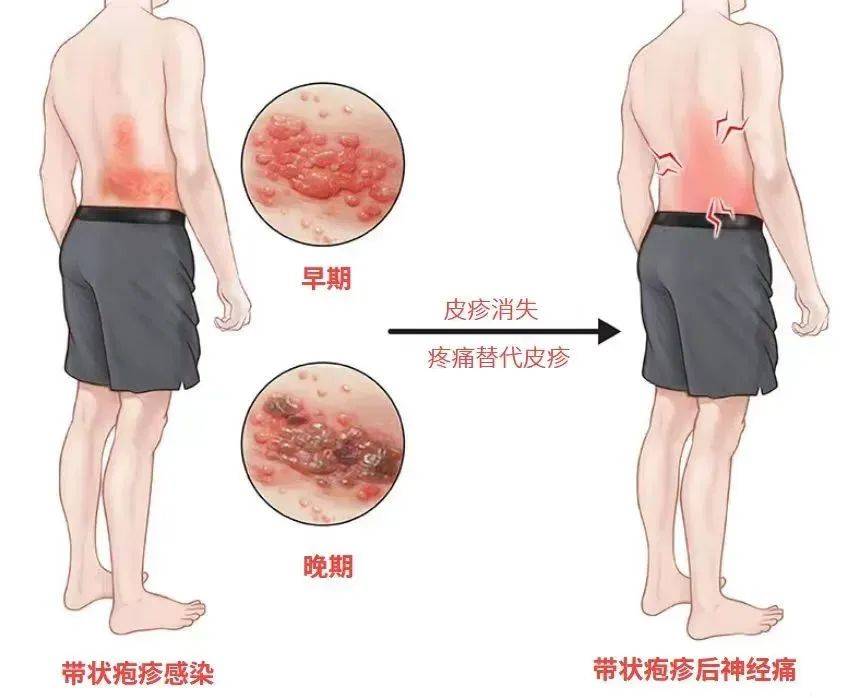 一旦感染终身携带<strong></p>
<p>证券交易费用</strong>！深圳疾控提醒：这4类人要注意