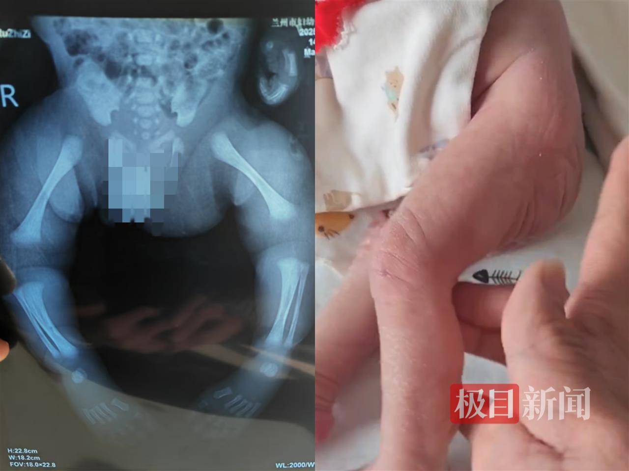 二胎出生查出先天性病症或落下残疾<strong></p>
<p>虚拟币eos</strong>，残疾父母称医院产检漏检、未尽告知义务，医院及医调委回应