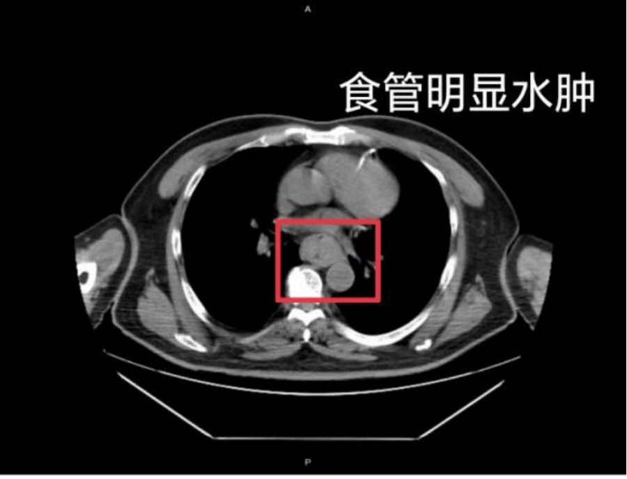 【家常话健康】一口热汤<strong></p>
<p>买卖虚拟币</strong>，差点要了幼童的命！不是所有东西都适合“趁热吃”