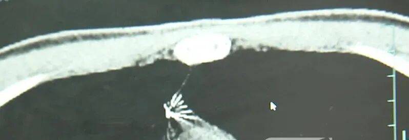 17岁小伙参军体检发现胸腔内有根5cm缝衣针<strong></p>
<p>pvc现货价格行情</strong>,父母回忆或是1岁时扎入,取出时已锈迹斑斑