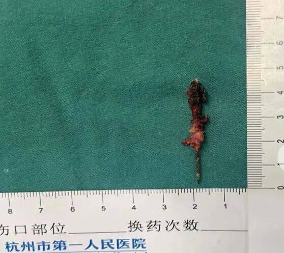 17岁小伙参军体检发现胸腔内有根5cm缝衣针<strong></p>
<p>pvc现货价格行情</strong>,父母回忆或是1岁时扎入,取出时已锈迹斑斑